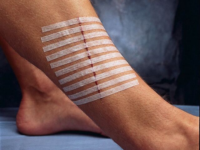 3M Steri-strip sårstrips, 6 x 100 mm (10 stk i pose) - Pakke  m/50 poser 